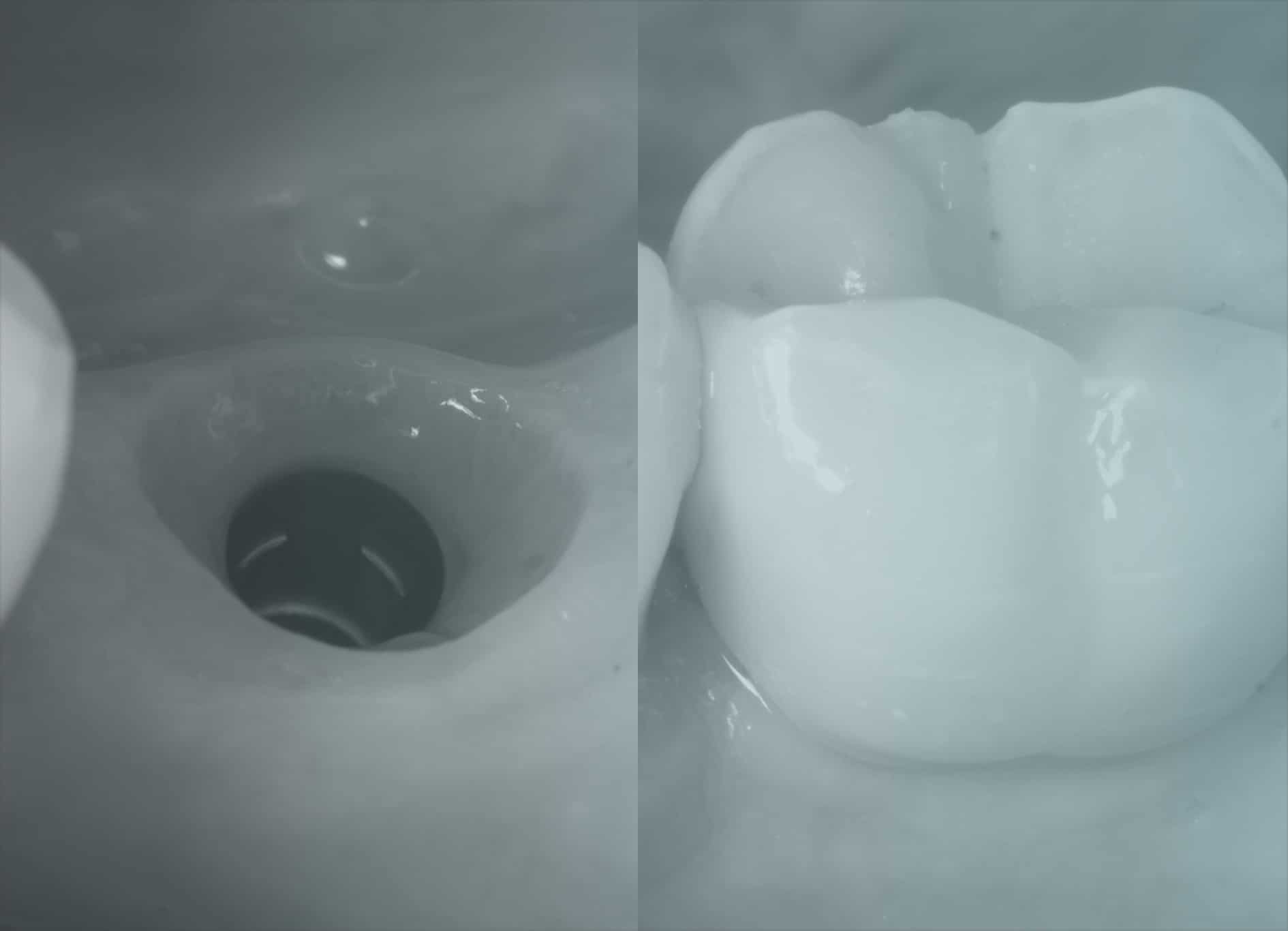 Implantologie | Pose d'implant dentaire | Cabinet dentaire | Dr Alexandre Sarfati | Paris 16